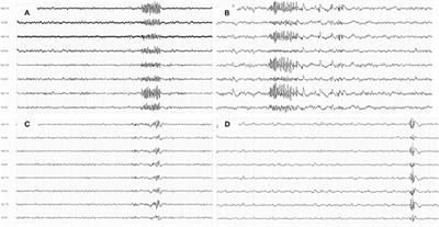 Generalized Fast Discharges Along the Genetic Generalized Epilepsy Spectrum: Clinical and Prognostic Significance